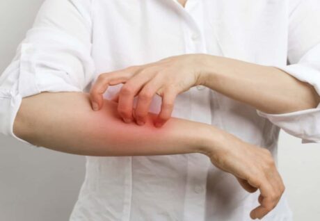 Dermatoloji Hastalarının Yüzde 20’si Uyuz Vakası