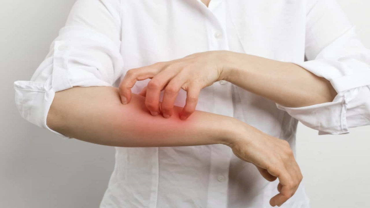 Dermatoloji Hastalarının Yüzde 20’si Uyuz Vakası