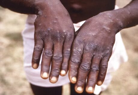 Kongo’da Maymun Çiçeği Virüsü Alarmı: 581 Kişi Hayatını Kaybetti