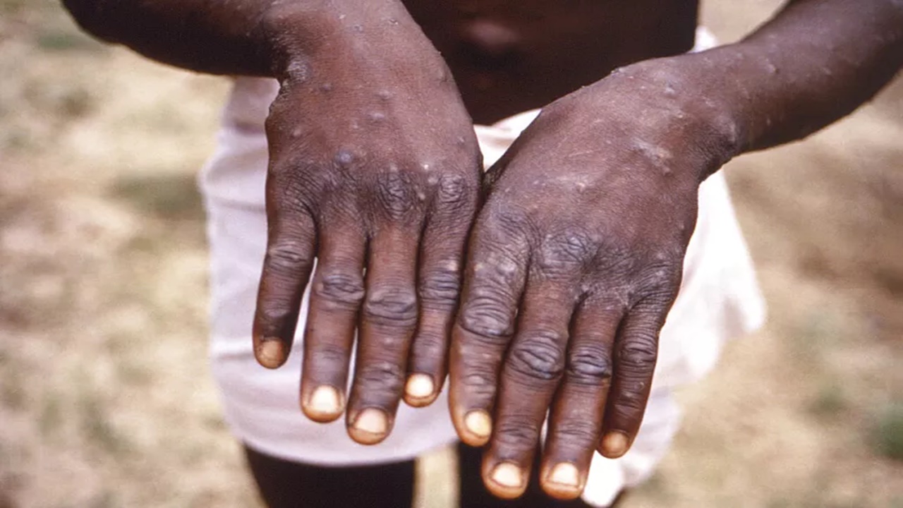 Kongo’da Maymun Çiçeği Virüsü Alarmı: 581 Kişi Hayatını Kaybetti