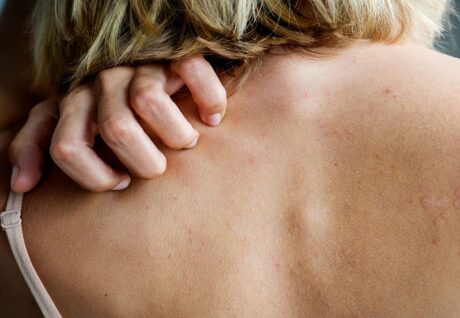 Uyuz Vakaları Artıyor: Dermatoloji Kliniklerinde Yüzde 25 Artış