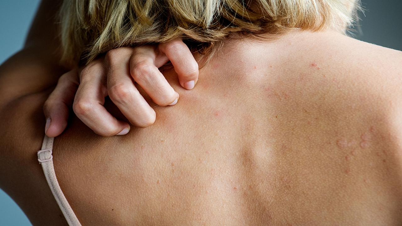 Uyuz Vakaları Artıyor: Dermatoloji Kliniklerinde Yüzde 25 Artış